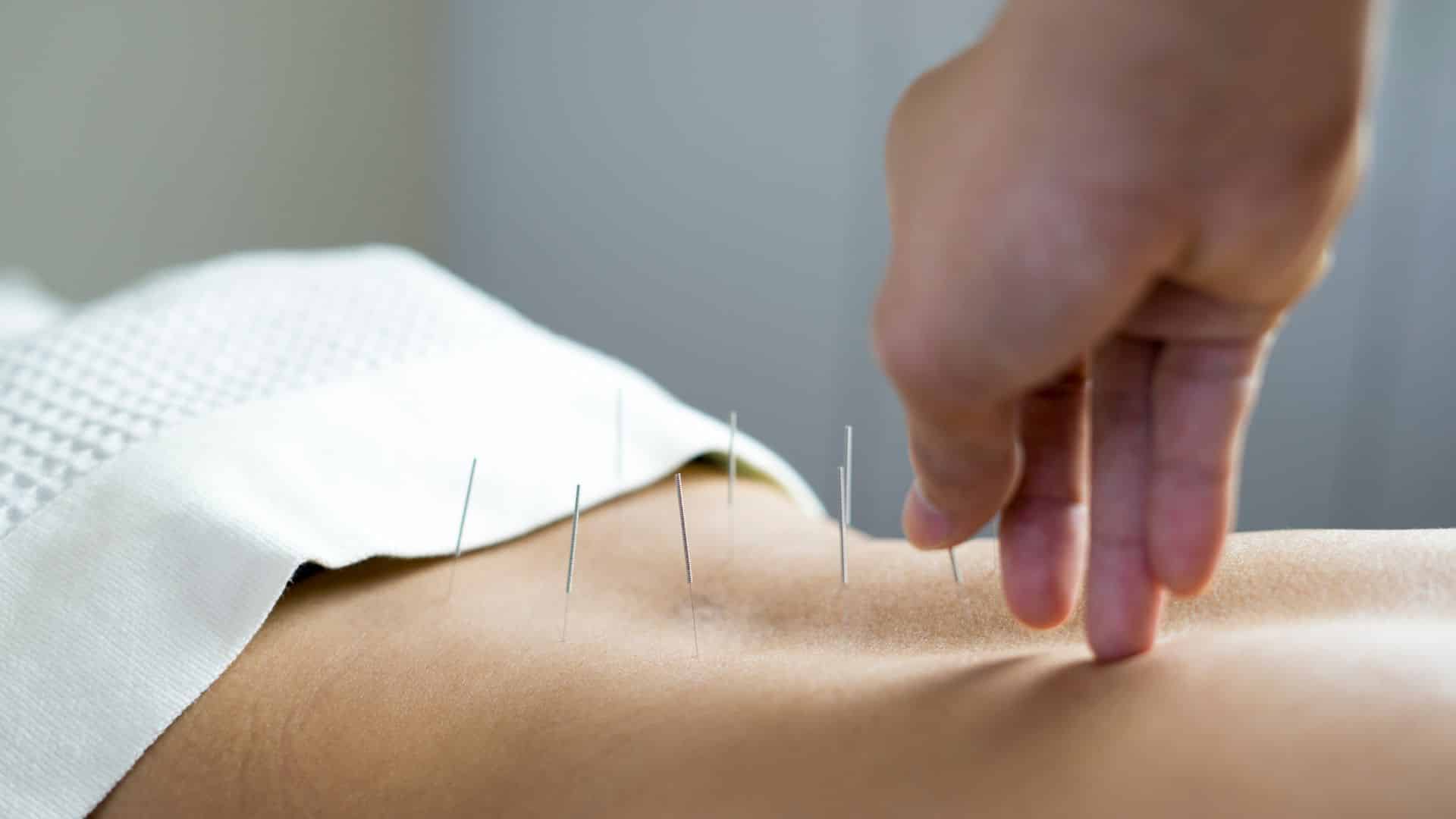 Acupuncture Therapy