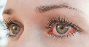 Close up of a green eye with redness in the sclera and visible lashes suggesting irritation or conjunctivitis