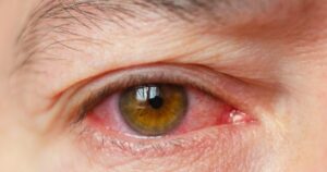Close up of a human eye with a hazel brown iris and red irritated sclera with visible blood vessels